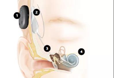 助听器和人工耳蜗，你知道有什么不同吗？