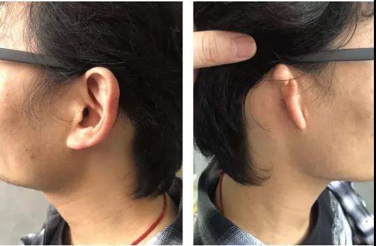 牙骨传导技术干预单侧传导性听力损失（小耳畸形）